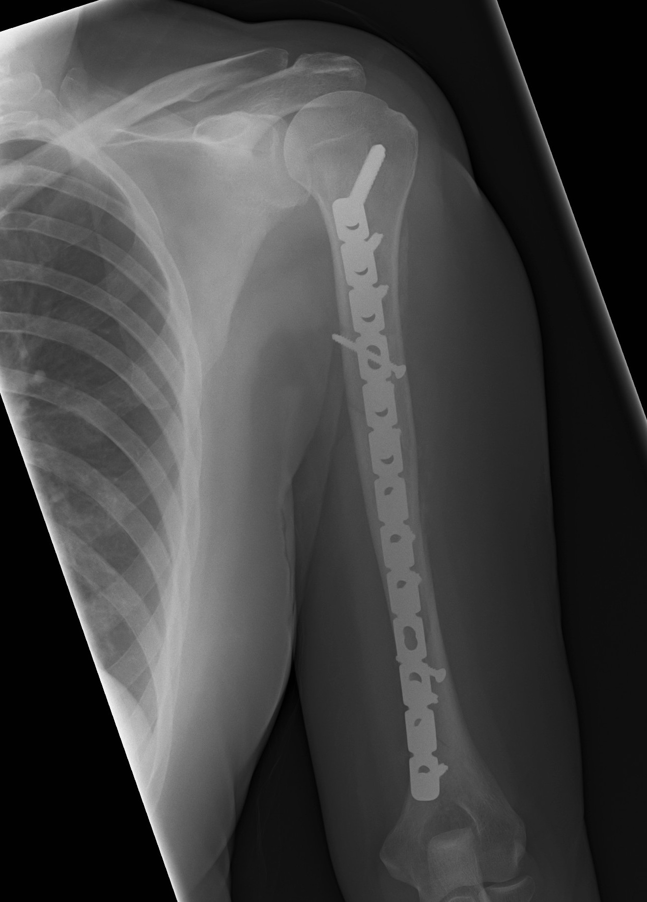 Humeral Plate Long AP
